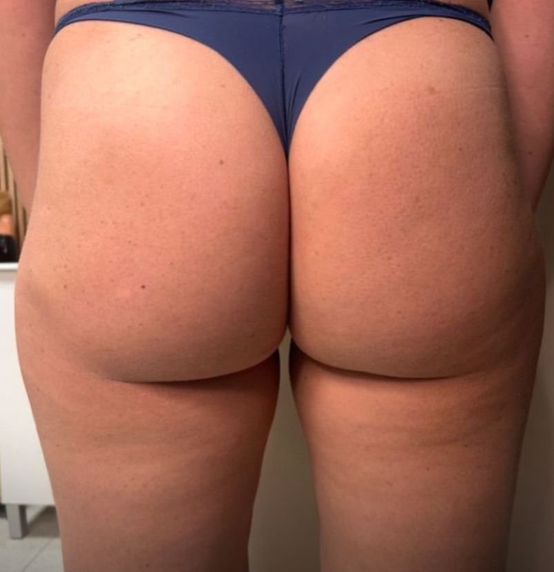 DESPUÉS Vacunterapia + Radio