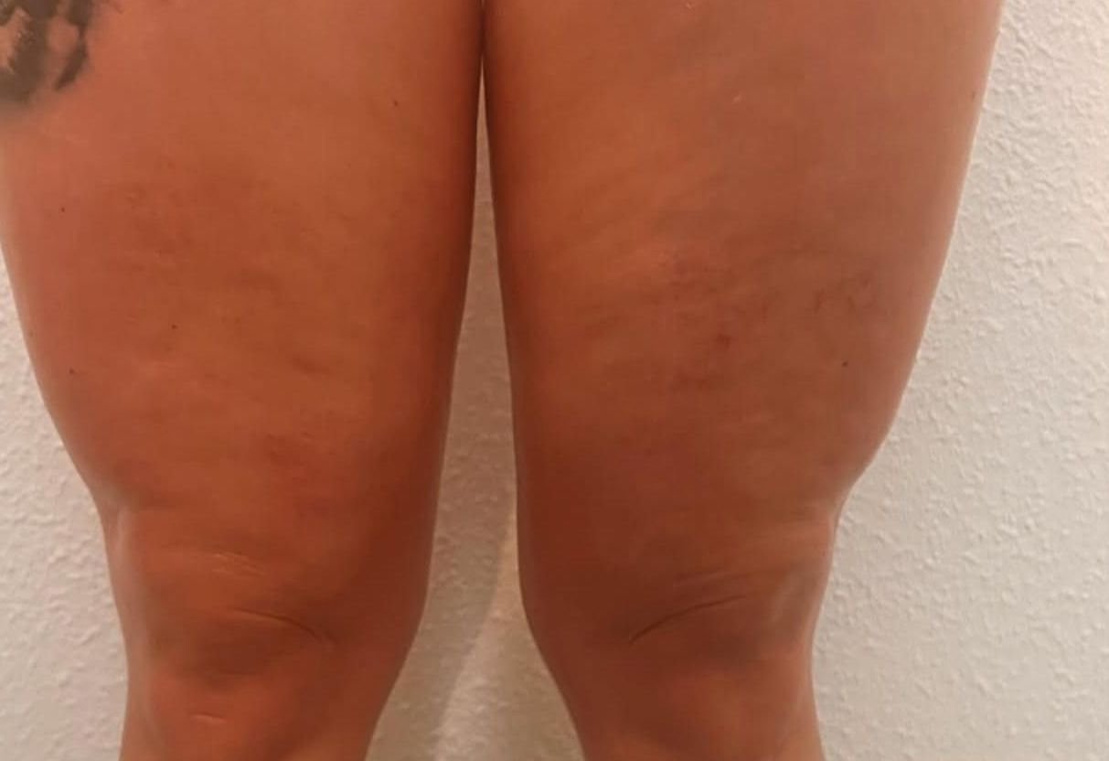 DESPUÉS Cavitación + Drenaje