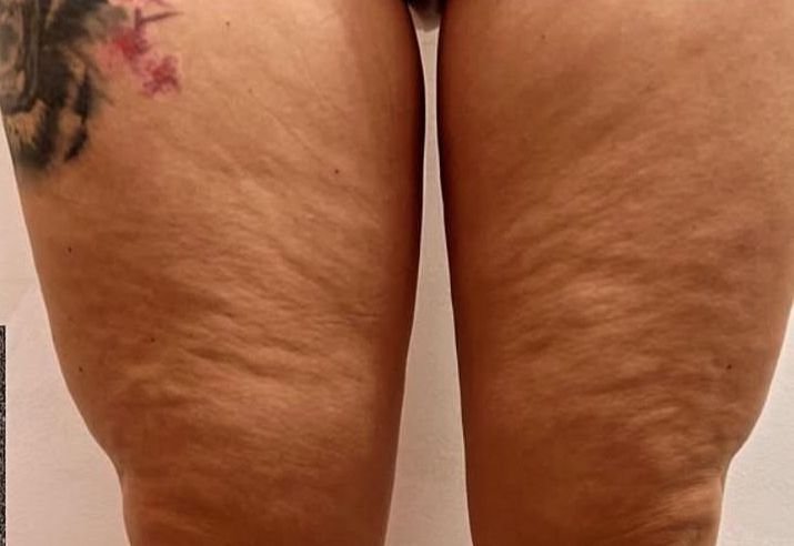 ANTES Cavitación + Drenaje