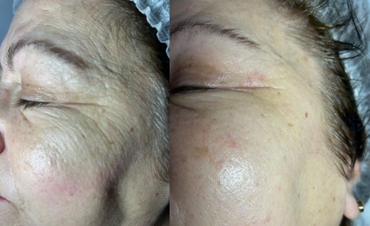 Hifu + Indiba + Vitaminas Derma